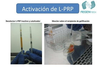 <ul><li>Recolectar L-PRP inactivo y catalizador </li></ul><ul><li>Mezclar sobre el recipiente de gelificación </li></ul>Ac...