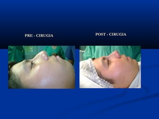 PRE - CIRUGIA   POST - CIRUGIA
 