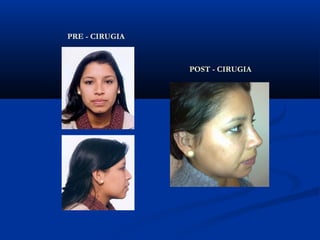 PRE - CIRUGIA



                POST - CIRUGIA
 