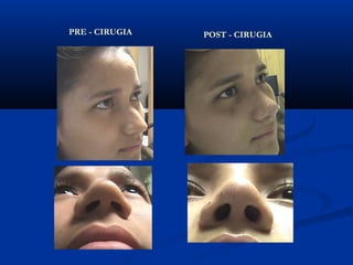 PRE - CIRUGIA   POST - CIRUGIA
 