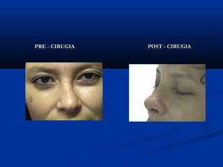 PRE - CIRUGIA   POST - CIRUGIA
 