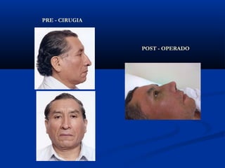 PRE - CIRUGIA




                POST - OPERADO
 