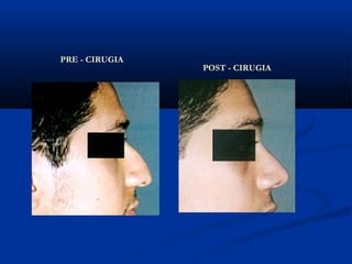 PRE - CIRUGIA
                POST - CIRUGIA
 
