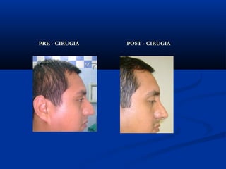 PRE - CIRUGIA   POST - CIRUGIA
 