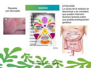 María Martínez García _ MiMAGA 1
Rosacéa
con Dermatitis
ETIOLOGÍA
La causa de la rosácea se
desconoce y se considera
que pueden intervenir
diversos factores sobre
una posible predisposición
genética:
 