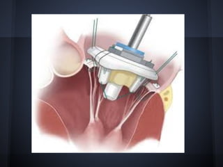 Cardiac valvulopathy - Maria Bouzaid