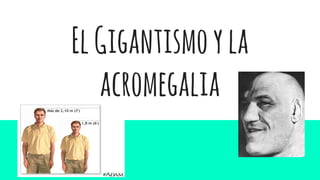 ElGigantismoyla
acromegalia
 