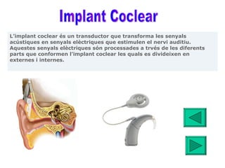 Implant Coclear 1 L’implant coclear és un transductor que transforma les senyals acústiques en senyals elèctriques que estimulen el nervi auditiu. Aquestes senyals elèctriques són processades a trvés de les diferents parts que conformen l’implant coclear les quals es divideixen en externes i internes. 