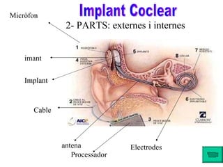 2- PARTS: externes i internes Implant Coclear Micròfon Cable imant Electrodes Implant antena Processador                                                                                         