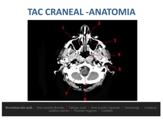TAC CRANEAL -ANATOMIA
 