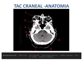 TAC CRANEAL -ANATOMIA
 