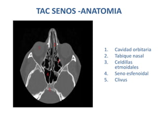 TAC SENOS -ANATOMIA
1. Cavidad orbitaria
2. Tabique nasal
3. Celdillas
etmoidales
4. Seno esfenoidal
5. Clivus
 