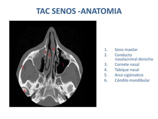 TAC SENOS -ANATOMIA
1. Seno maxilar
2. Conducto
nasolacrimal derecho
3. Cornete nasal
4. Tabique nasal
5. Arco cigómatico
6. Cóndilo mandibular
 
