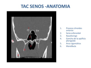 TAC SENOS -ANATOMIA
1. Proceso clinoides
anterior
2. Seno esfenoidal
3. Nasofaringe
4. Gancho de la apófisis
pterigoide
5. Arco cigomático
6. Mandíbula
 