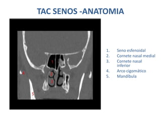 TAC SENOS -ANATOMIA
1. Seno esfenoidal
2. Cornete nasal medial
3. Cornete nasal
inferior
4. Arco cigomático
5. Mandíbula
 