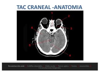 TAC CRANEAL -ANATOMIA
 