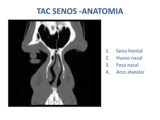 TAC SENOS -ANATOMIA
1. Seno frontal
2. Hueso nasal
3. Fosa nasal
4. Arco alveolar
 
