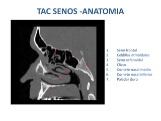 TAC SENOS -ANATOMIA
1. Seno frontal
2. Celdillas etmoidales
3. Seno esfenoidal
4. Clivus
5. Cornete nasal medio
6. Cornete nasal inferior
7. Paladar duro
 