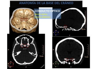 CONDUCTO ÓPTICO
Nervio óptico
Arteria oftálmica
ANATOMÍA DE LA BASE DEL CRÁNEO
 