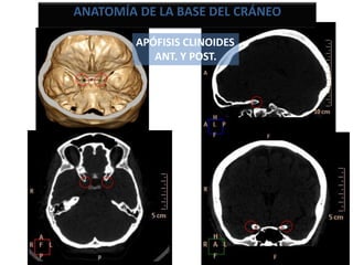 APÓFISIS CLINOIDES
ANT. Y POST.
ANATOMÍA DE LA BASE DEL CRÁNEO
 