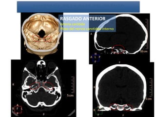 RASGADO ANTERIOR
Arteria carótida
Plexo del nervio carotideo interno
ANATOMÍA DE LA BASE DEL CRÁNEO
 