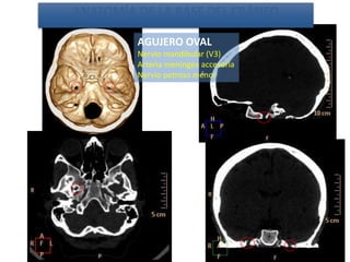 AGUJERO OVAL
Nervio mandibular (V3)
Arteria meníngea accesoria
Nervio petroso menor
ANATOMÍA DE LA BASE DEL CRÁNEO
 
