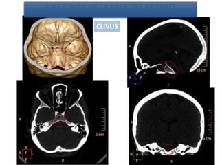 CLIVUS
ANATOMÍA DE LA BASE DEL CRÁNEO
 