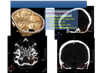 SENO SIGMOIDEO Y
AGUJERO YUGULAR
Nervio glosofaríngeo (IX)
Nervio vago (X)
Nervio accesorio (IX)
Arteria meníngea posterior
ANATOMÍA DE LA BASE DEL CRÁNEO
 