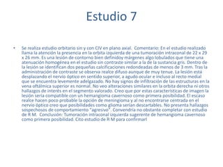 Estudio 7
• Se realiza estudio orbitario sin y con CIV en plano axial. Comentario: En el estudio realizado
llama la atención la presencia en la orbita izquierda de una tumoración intraconal de 22 x 29
x 26 mm. Es una lesión de contorno bien definidoy márgenes algo lobulados que tiene una
atenuación homogénea en el estudio sin contraste similar a la de la sustancia gris. Dentro de
la lesión se identifican dos pequeñas calcificaciones redondeadas de menos de 3 mm. Tras la
administración de contraste se observa realce difuso aunque de muy tenue. La lesión está
desplazando el nervio óptico en sentido superior, a agudo ocular e incluso al recto medial
que se encuentra levemente adelgazado. No hay signos de infiltración de las estructuras en la
vena oftálmica superior es normal. No veo alteraciones similares en la orbita derecha ni otros
hallazgos de interés en el segmento valorado. Creo que por estas características de imagen la
lesión sería compatible con un hemangioma cavernoso como primera posibilidad. El escaso
realce hacen poco probable la opción de meningioma y al no encontrarse centrada en el
nervio óptico creo que posibilidades como glioma serían descartables. No presenta hallazgos
sospechosos de comportamiento "agresivo". Convendría no obstante completar con estudio
de R M. Conclusión: Tumoración intraconal izquierda sugerente de hemangioma cavernoso
como primera posibilidad. Cito estudio de R M para confirmarl
 