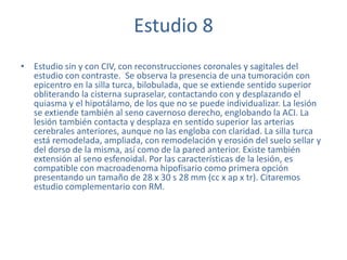Estudio 8
• Estudio sin y con CIV, con reconstrucciones coronales y sagitales del
estudio con contraste. Se observa la presencia de una tumoración con
epicentro en la silla turca, bilobulada, que se extiende sentido superior
obliterando la cisterna supraselar, contactando con y desplazando el
quiasma y el hipotálamo, de los que no se puede individualizar. La lesión
se extiende también al seno cavernoso derecho, englobando la ACI. La
lesión también contacta y desplaza en sentido superior las arterias
cerebrales anteriores, aunque no las engloba con claridad. La silla turca
está remodelada, ampliada, con remodelación y erosión del suelo sellar y
del dorso de la misma, así como de la pared anterior. Existe también
extensión al seno esfenoidal. Por las características de la lesión, es
compatible con macroadenoma hipofisario como primera opción
presentando un tamaño de 28 x 30 s 28 mm (cc x ap x tr). Citaremos
estudio complementario con RM.
 