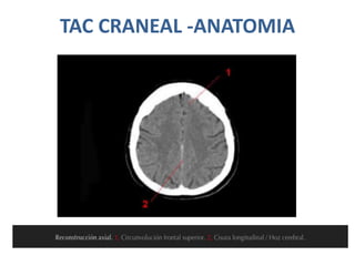 TAC CRANEAL -ANATOMIA
 
