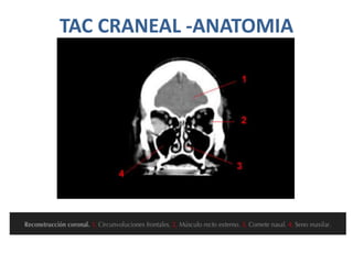 TAC CRANEAL -ANATOMIA
 