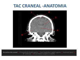 TAC CRANEAL -ANATOMIA
 