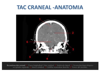 TAC CRANEAL -ANATOMIA
 