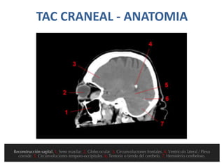 TAC CRANEAL - ANATOMIA
 