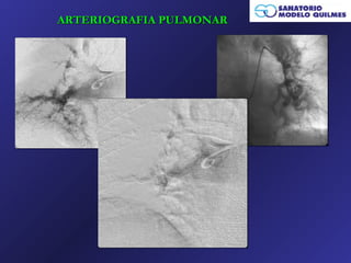 ARTERIOGRAFIA PULMONAR
 