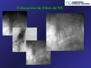Colocación de Filtro de VC
 