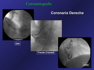 Coronariografia

                       Coronaria Derecha




OAI


            Frente Craneal




                                       OAD
 