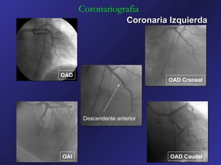 Coronariografia
                       Coronaria Izquierda




OAD
                                OAD Craneal




       Descendente anterior




OAI                              OAD Caudal
 
