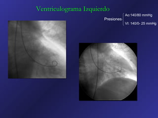 Ventriculograma Izquierdo
                                   Ao:140/80 mmHg
                       Presiones
                                   VI: 140/0- 25 mmHg
 