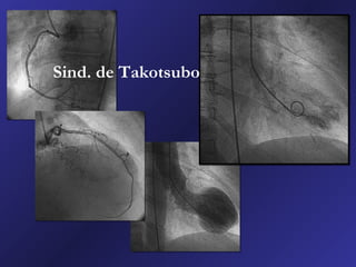 Sind. de Takotsubo
 