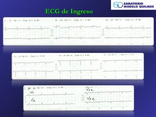 ECG de Ingreso
 