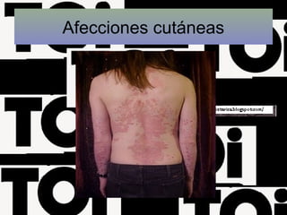 Afecciones cutáneas
 