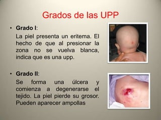 Grados de las UPP
• Grado I:
  La piel presenta un eritema. El
  hecho de que al presionar la
  zona no se vuelva blanca,
  indica que es una upp.

• Grado II:
  Se forma una úlcera y
  comienza a degenerarse el
  tejido. La piel pierde su grosor.
  Pueden aparecer ampollas
 