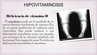 HIPOVITAMINOSIS
Deficiencia de vitamina D
El raquitismo puede ser el resultado de un
aporte dietético insuficiente de vitamina D, o
de un aporte insuficiente de radiación solar
ultravioleta. Esto puede conducir a una
deformación esquelética como, por ejemplo,
una curvatura de la columna vertebral o de
las piernas. Esta imagen de rayos X revela una
deformación ósea debida al raquitismo

 