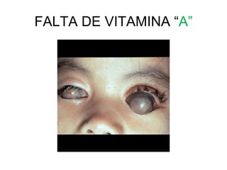 FALTA DE VITAMINA “A”
 