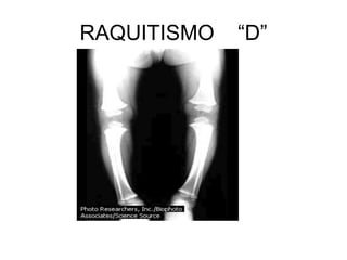 RAQUITISMO “D”
 