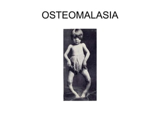 OSTEOMALASIA
 
