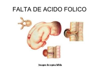 FALTA DE ACIDO FOLICO
 