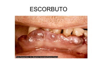 ESCORBUTO
 